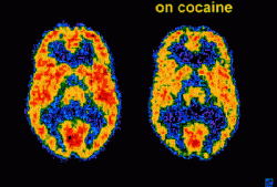 cocaine brain effects